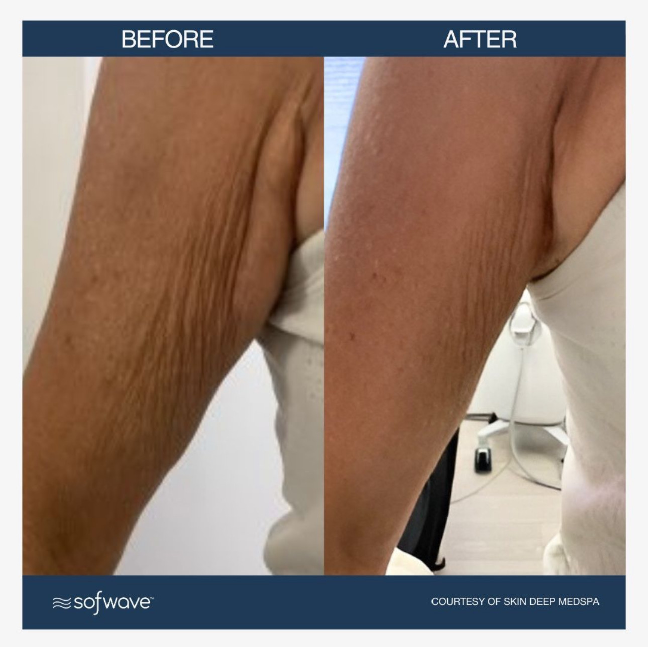 Buttocks Implants before and after - after