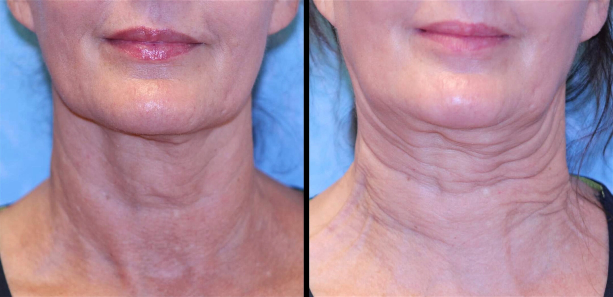 Sofwave before and after - after