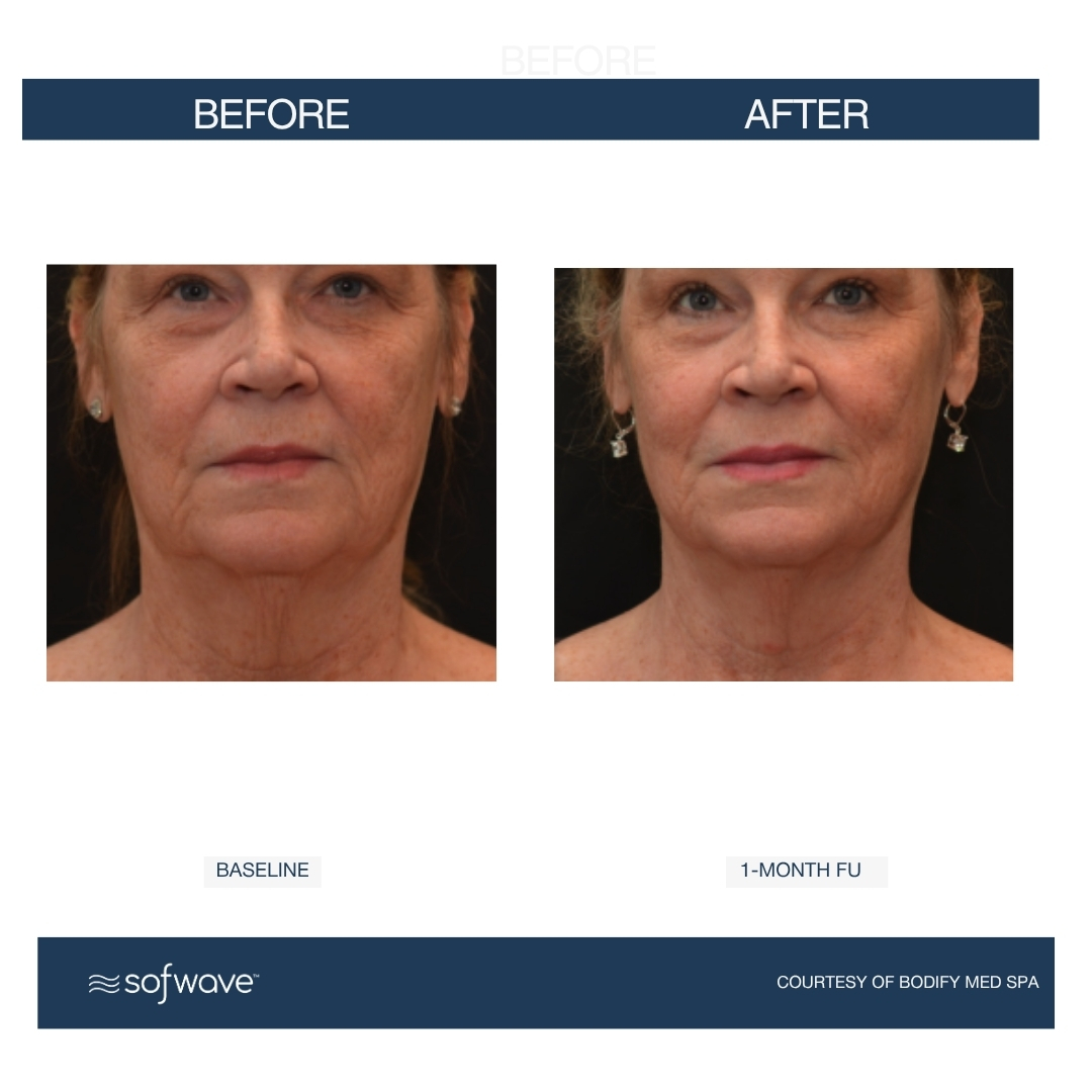 Sofwave before and after - after