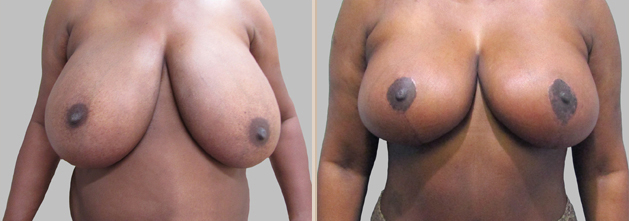 Mommy Makeover before and after - before