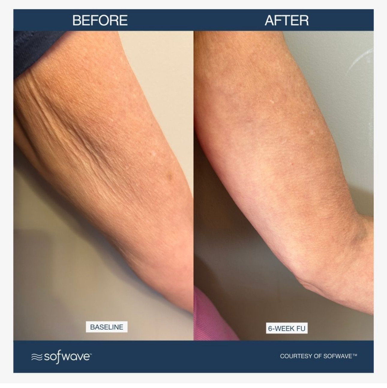 Sofwave before and after - before