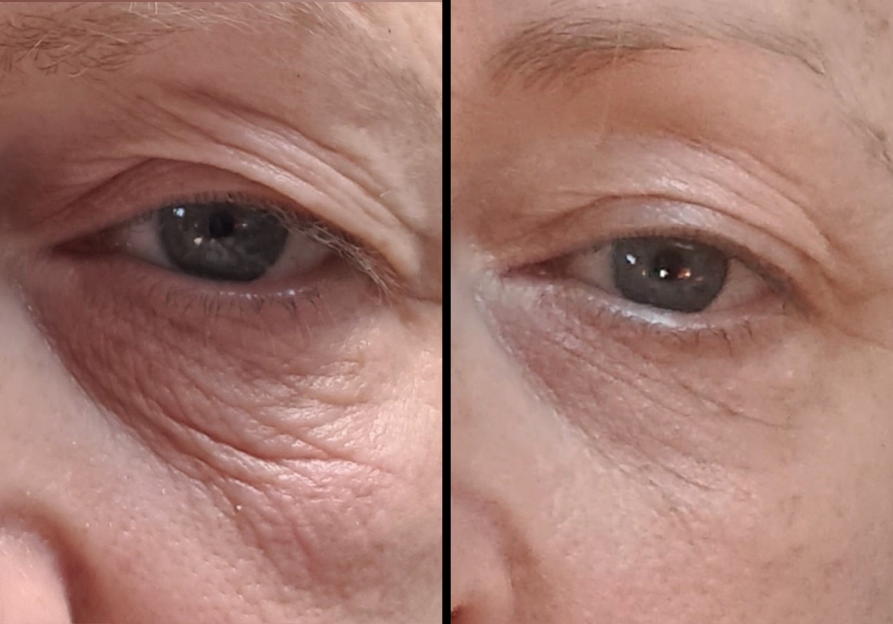 Sofwave before and after - before