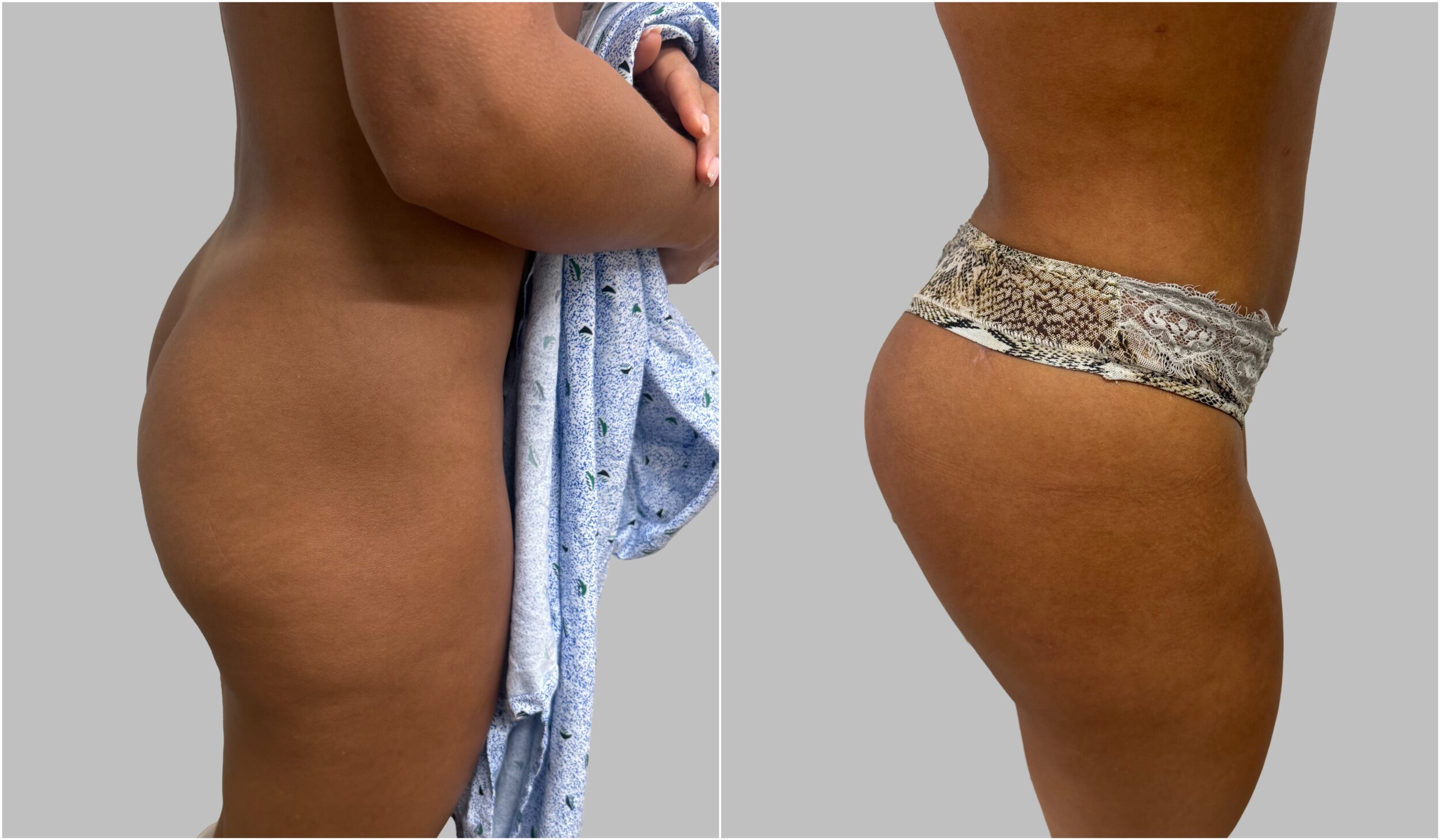 Buttocks Implants before and after - before