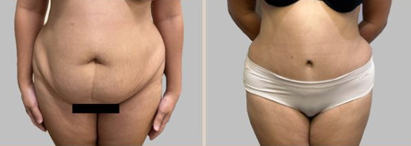Abdominoplasty (Tummy Tuck) before and after - before