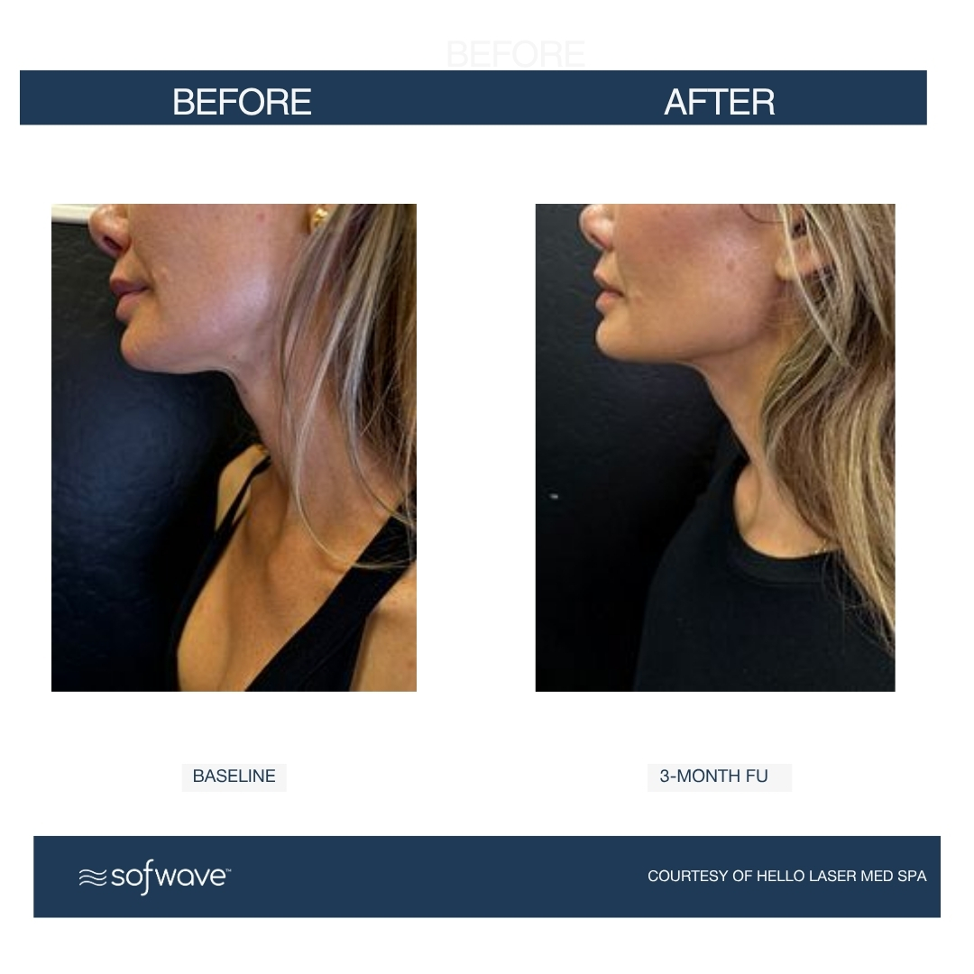 Sofwave before and after - before