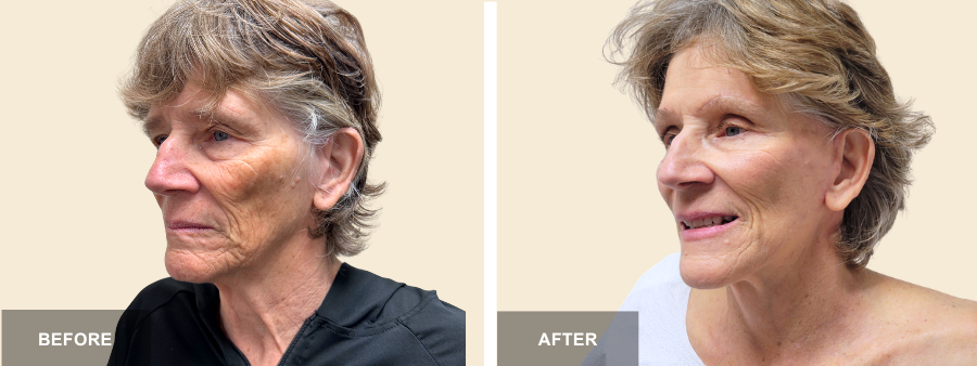 Face, Neck Lift, & Upper Bleph before and after - after