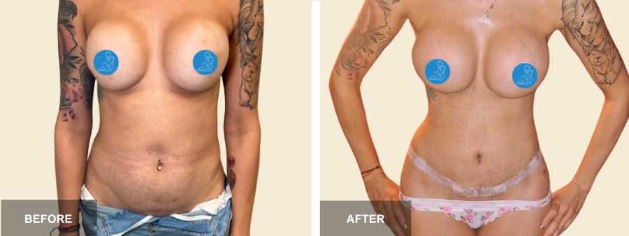Otoplasty before and after - after