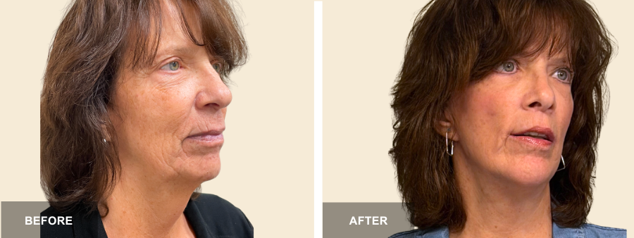 Face Lift, Rhino, & Chin Implant before and after - after