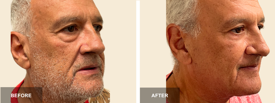Lower Bleph before and after - after