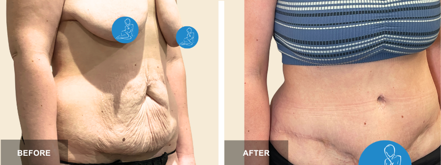 Tummy Tuck before and after - after