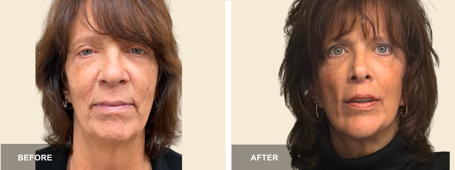 Face Lift, Rhino, & Chin Implant before and after - before