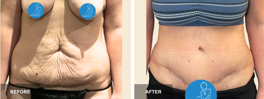 Tummy Tuck before and after - before