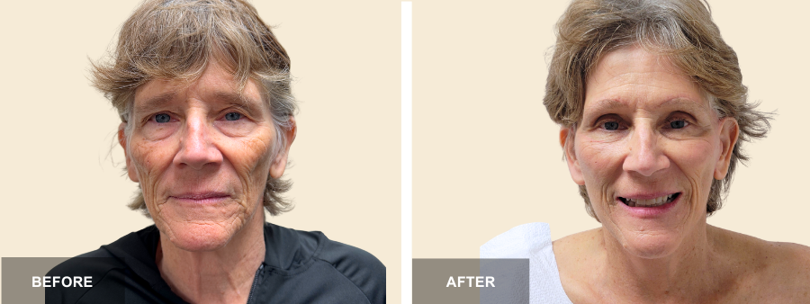 Face, Neck Lift, & Upper Bleph before and after - before