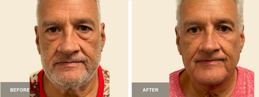 Lower Bleph before and after - before