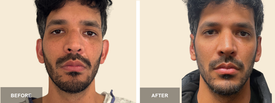 Otoplasty before and after - before