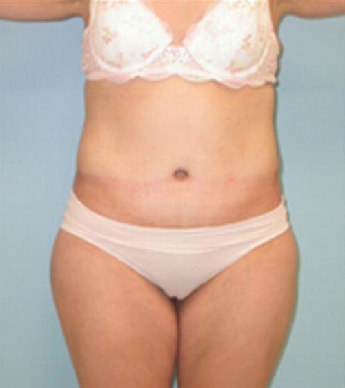 Body Lift before and after - after
