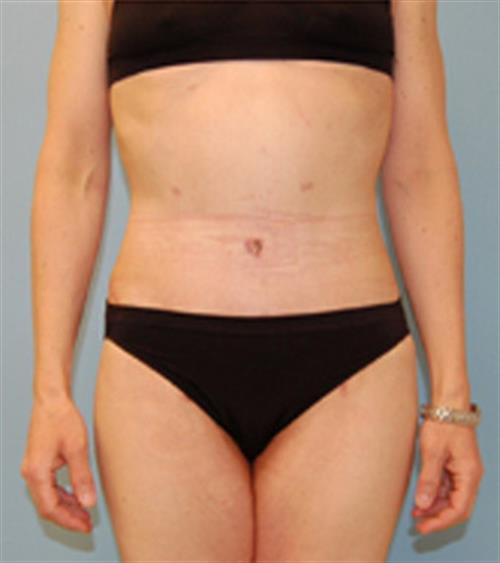 Body Lift before and after - after