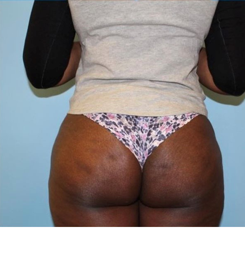BBL before and after - after