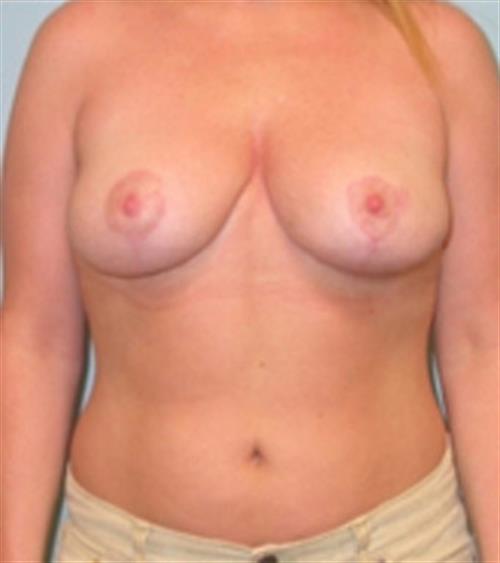 Breast Asymmetry Case 28 before and after - after