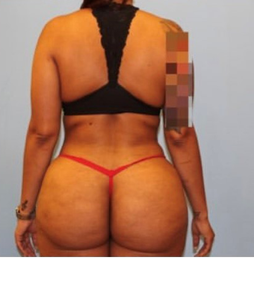 BBL before and after - after