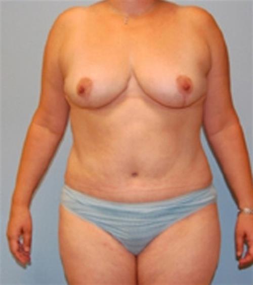 Breast Asymmetry Case 26 before and after - after