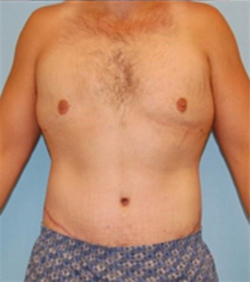 Body Lift before and after - after