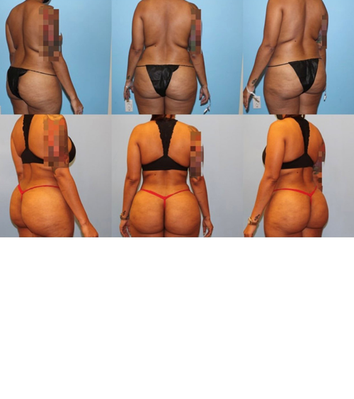 BBL before and after - before