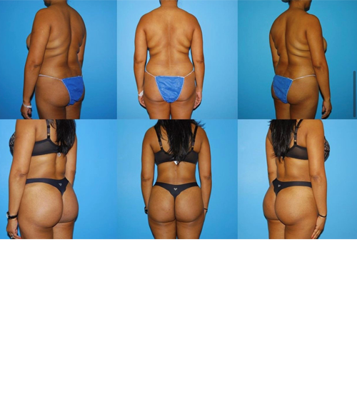BBL before and after - before
