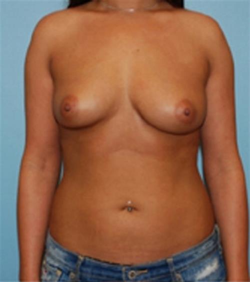 Breast Augmentation Case 30 before and after - before