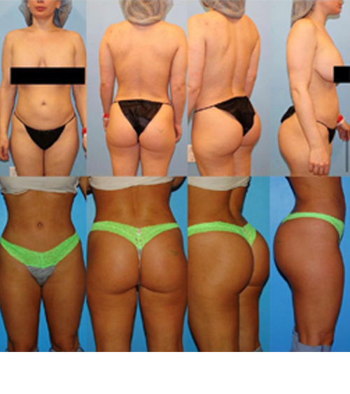 BBL before and after - before