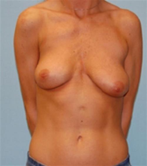 Breast Asymmetry Case 25 before and after - before