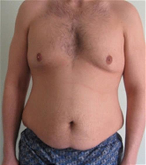 Body Lift before and after - before