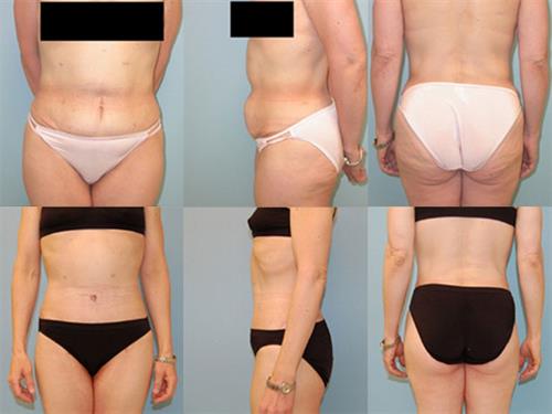 Body Lift before and after - before