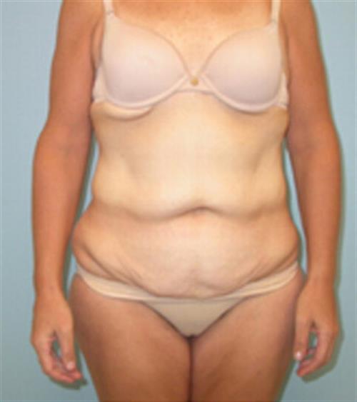 Body Lift before and after - before