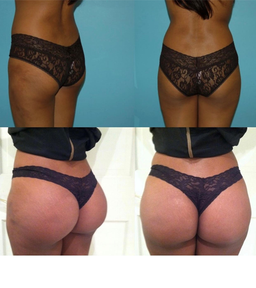 BBL before and after - before