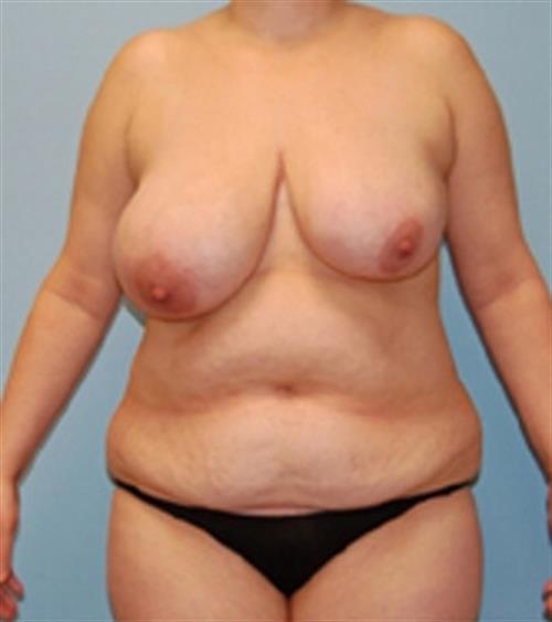 Breast Asymmetry Case 26 before and after - before