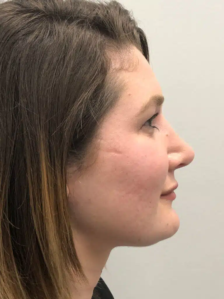 Procedure before and after - after