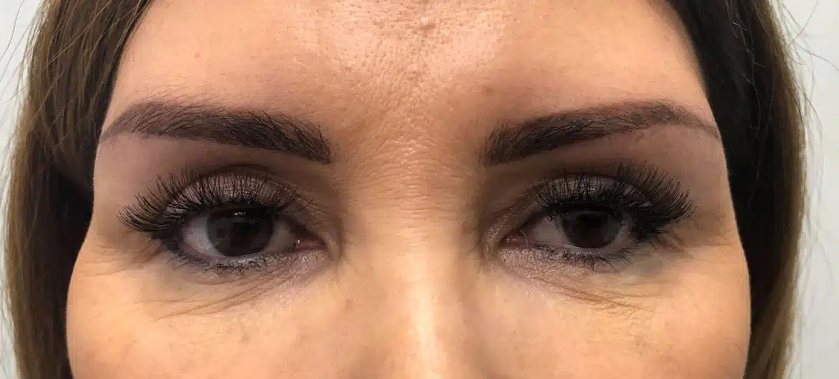 Procedure before and after - after