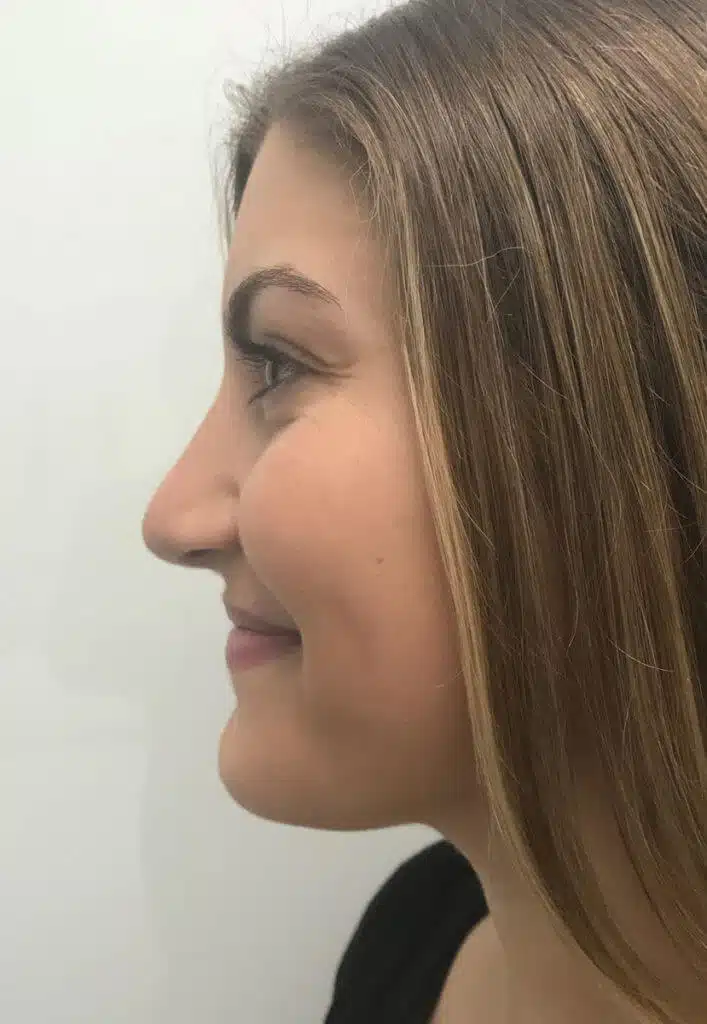 Procedure before and after - after