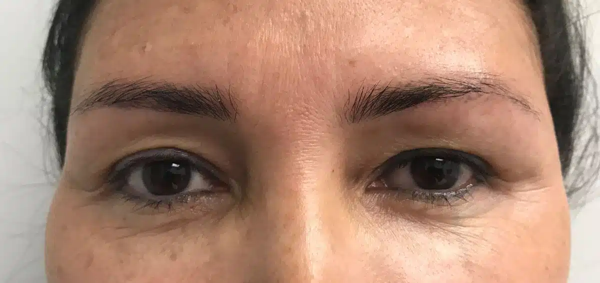 Procedure before and after - before