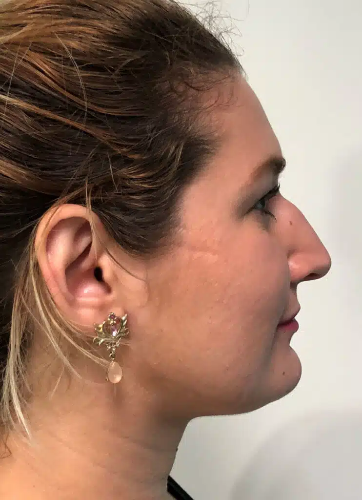 Procedure before and after - before