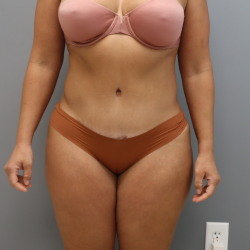 Procedure before and after - after