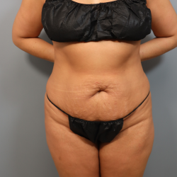 Procedure before and after - before