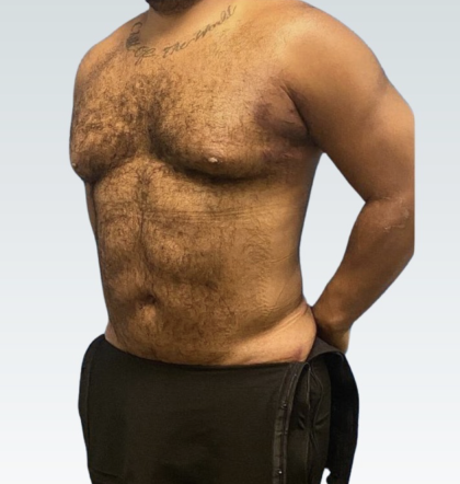 Abdominal Etching before and after - after