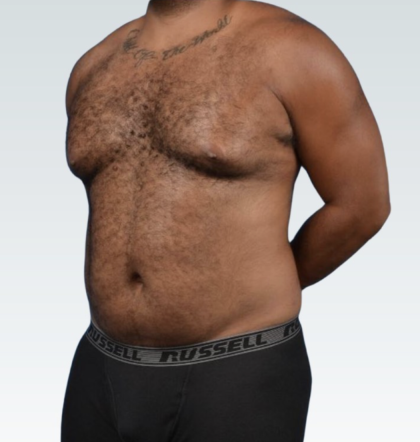 Abdominal Etching before and after - before