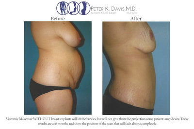 After Weight Loss & Mommy Make-over before and after - after