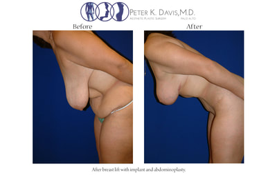After Weight Loss & Mommy Make-over before and after - after