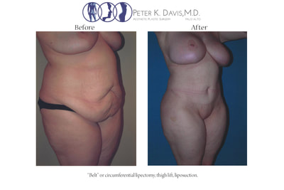 After Weight Loss & Mommy Make-over before and after - after
