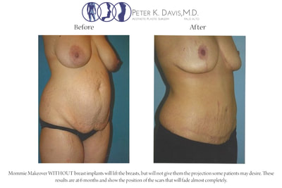 After Weight Loss & Mommy Make-over by Dr. Peter Davis — before and after