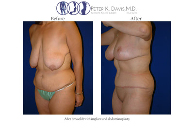 After Weight Loss & Mommy Make-over by Dr. Peter Davis — before and after